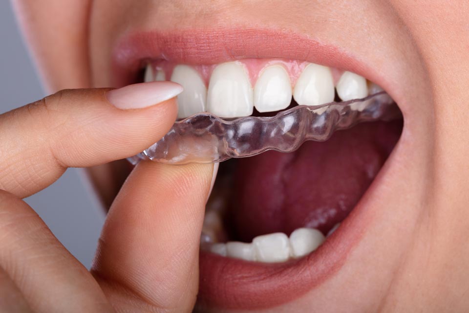 Кап для зубов фото 5 Benefits of Invisalign Braces - A Health Education Library Project